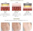 Mlay T8（ダークゴールド）IPLレーザー永久脱毛、50万回フラッシュ、氷冷却、FDA認証