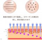 Dr. Pen A8s 電動マイクロニードリングダーマペン、36ピンニードル10本